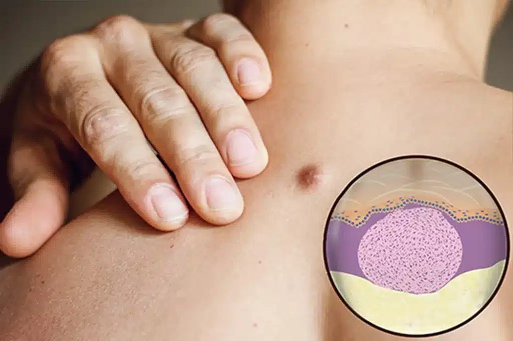 Tretman uklanjanja fibroma u Alfa Estetika ordinaciji