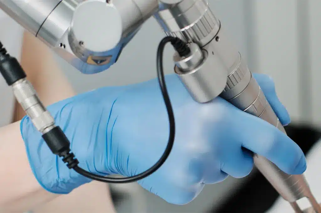 Uklanjanje kondiloma laserom u Alfa Estetika ordinaciji