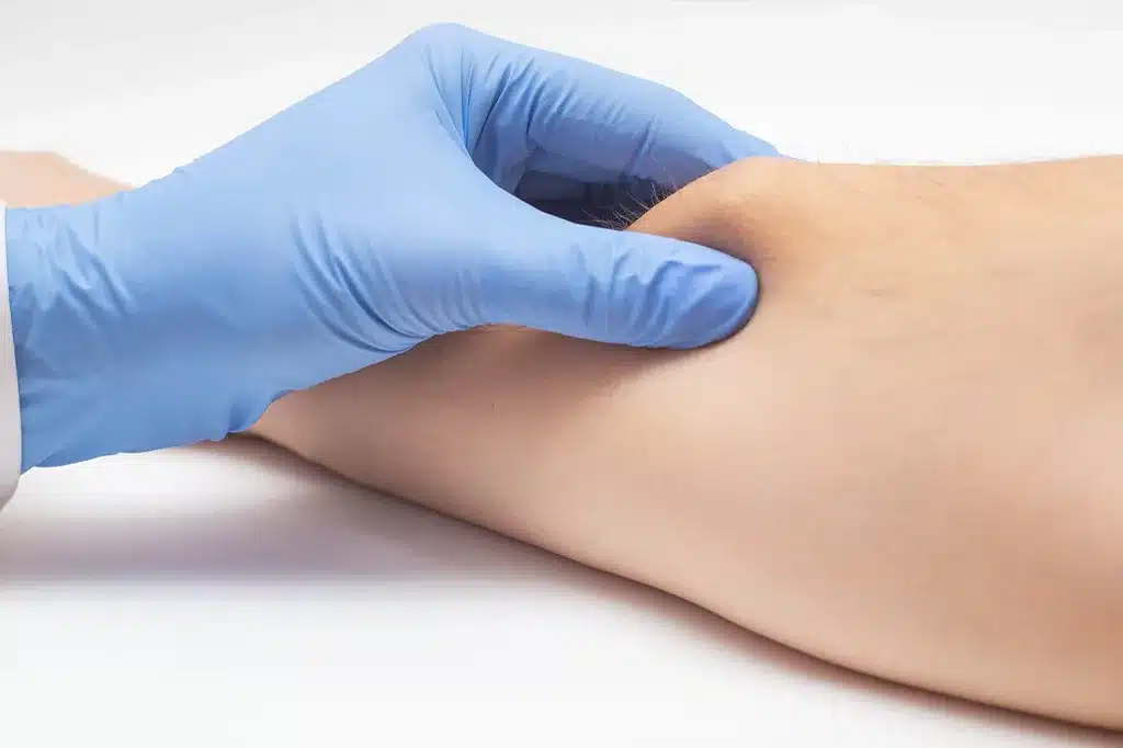 Hirurško uklanjanje lipoma u Alfa Estetika ordinaciji