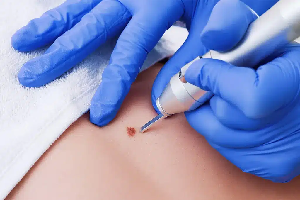 Uklanjanje mladeža u Alfa Estetika ordinaciji