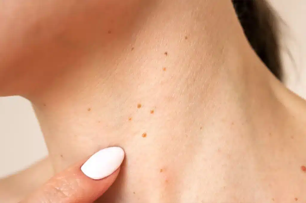 Tretman uklanjanja virusnih bradavica u Alfa Estetika ordinaciji